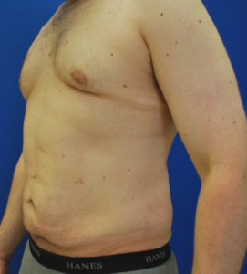 Gynecomastia (Male Chest Surgery) Before and After Pictures Buffalo, NY