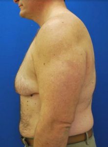 Gynecomastia (Male Chest Surgery) Before and After Pictures Buffalo, NY