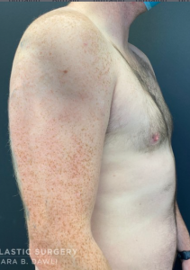 Gynecomastia (Male Chest Surgery) Before and After Pictures in Buffalo, NY