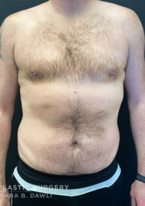 Gynecomastia (Male Chest Surgery) Before and After Pictures in Buffalo, NY