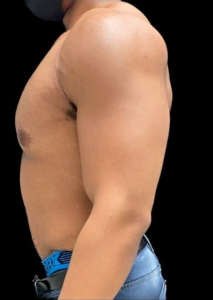 Gynecomastia (Male Chest Surgery) Before and After Pictures in Buffalo, NY