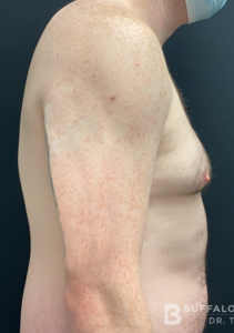 Gynecomastia (Male Chest Surgery) Before and After Pictures in Buffalo, NY
