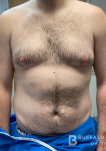 Gynecomastia (Male Chest Surgery) Before and After Pictures in Buffalo, NY