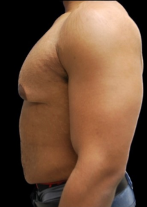 Gynecomastia (Male Chest Surgery) Before and After Pictures in Buffalo, NY