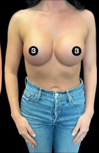 Breast Augmentation Before and After Pictures in Buffalo, NY