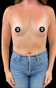 Breast Augmentation Before and After Pictures in Buffalo, NY