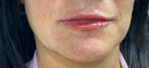 Lip Augmentation Before and After Pictures Buffalo, NY