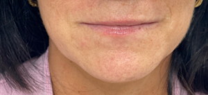 Lip Augmentation Before and After Pictures Buffalo, NY