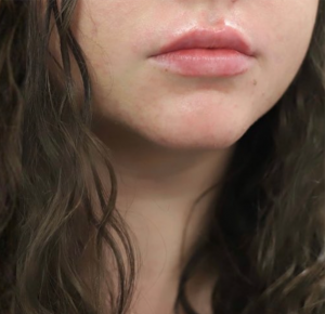 Lip Fillers Before and After Pictures in Buffalo, NY