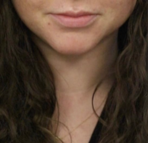 Lip Fillers Before and After Pictures in Buffalo, NY