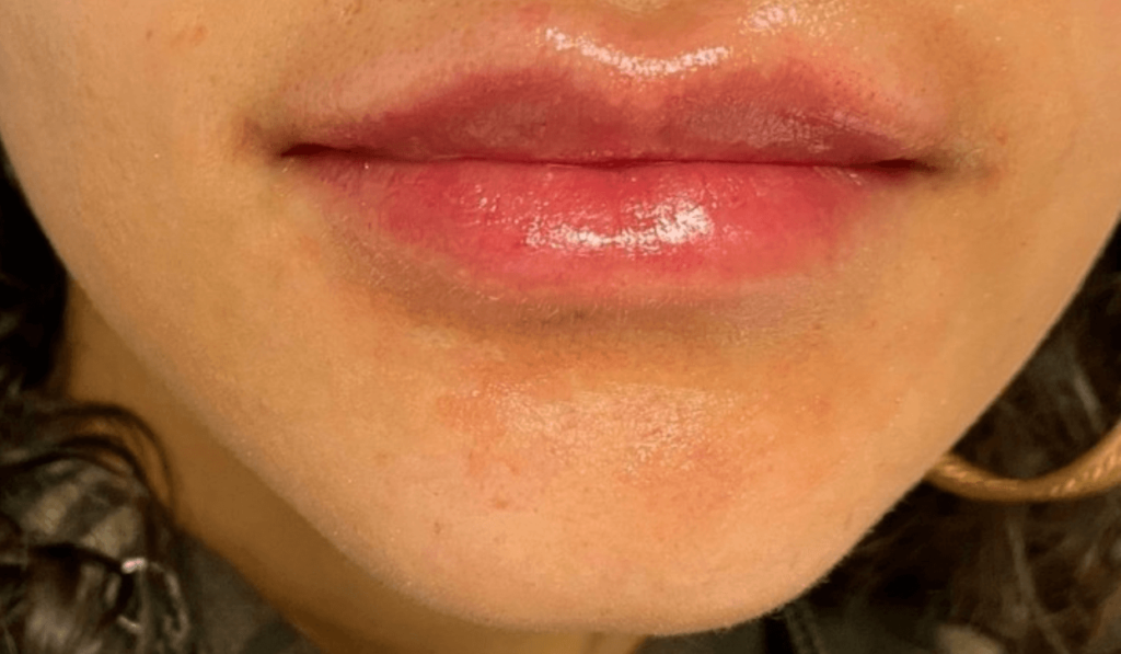 Lip Fillers Before and After Pictures in Buffalo, NY