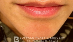Lip Fillers Before and After Pictures in Buffalo, NY