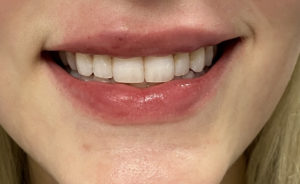 Fillers Before and After Pictures Buffalo, NY