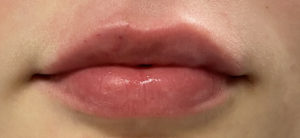 Fillers Before and After Pictures Buffalo, NY