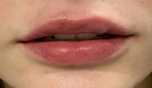 Fillers Before and After Pictures Buffalo, NY