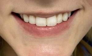Fillers Before and After Pictures Buffalo, NY