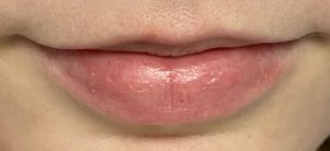 Fillers Before and After Pictures Buffalo, NY