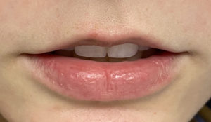 Fillers Before and After Pictures Buffalo, NY