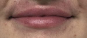Lip Augmentation Before and After Pictures Buffalo, NY