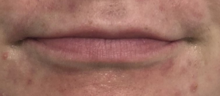 Lip Augmentation Before and After Pictures Buffalo, NY