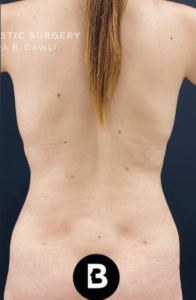Liposuction Before and After Pictures in Buffalo, NY