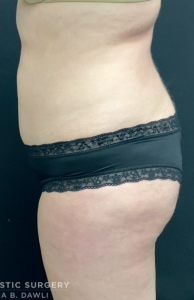Liposuction Before and After Pictures in Buffalo, NY