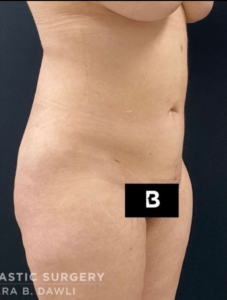 Liposuction Before and After Pictures in Buffalo, NY