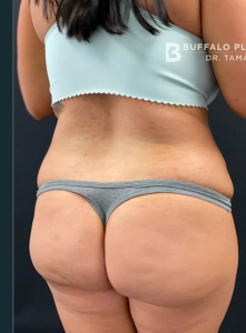 Liposuction Before and After Pictures in Buffalo, NY
