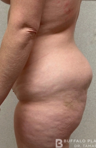Liposuction Before and After Pictures in Buffalo, NY