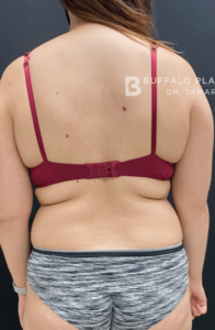 Liposuction Before and After Pictures in Buffalo, NY