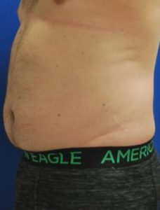 Liposuction Before and After Pictures Buffalo, NY