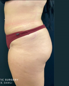 Liposuction Before and After Pictures in Buffalo, NY