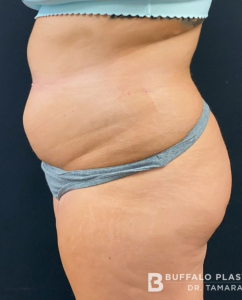 Liposuction Before and After Pictures in Buffalo, NY