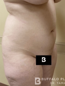 Liposuction Before and After Pictures in Buffalo, NY