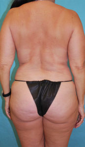 Liposuction Before and After Pictures Buffalo, NY