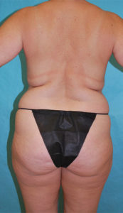 Liposuction Before and After Pictures Buffalo, NY