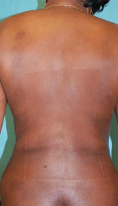 Liposuction Before and After Pictures Buffalo, NY