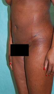 Liposuction Before and After Pictures Buffalo, NY