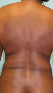 Liposuction Before and After Pictures Buffalo, NY