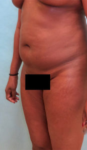 Liposuction Before and After Pictures Buffalo, NY