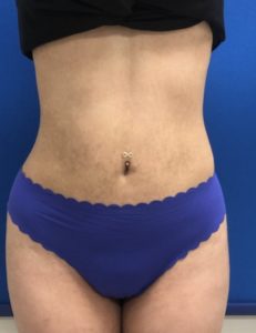 Liposuction Before and After Pictures Buffalo, NY