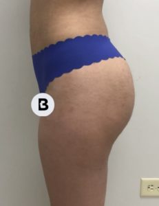 Liposuction Before and After Pictures Buffalo, NY