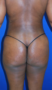 Liposuction Before and After Pictures Buffalo, NY