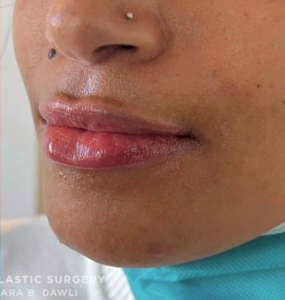 Lip Fillers Before and After Pictures in Buffalo, NY