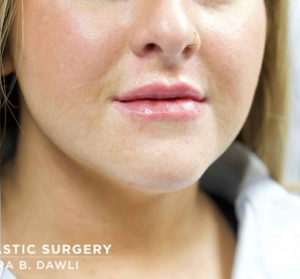 Lip Fillers Before and After Pictures in Buffalo, NY