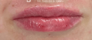 Lip Fillers Before and After Pictures in Buffalo, NY