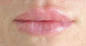 Lip Fillers Before and After Pictures in Buffalo, NY
