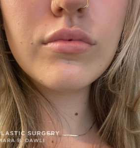 Lip Fillers Before and After Pictures in Buffalo, NY