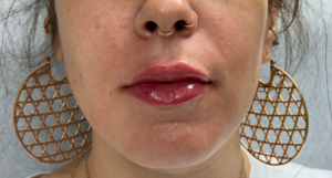 Lip Augmentation Before and After Pictures Buffalo, NY