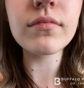 Lip Fillers Before and After Pictures in Buffalo, NY